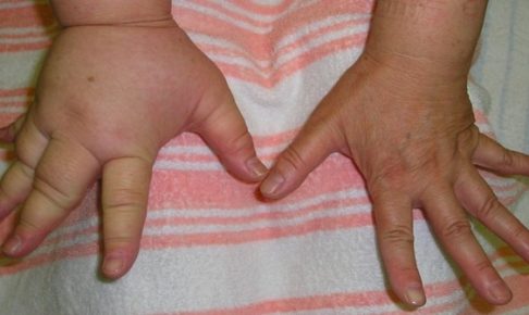病気 むくみ 手 の 手のむくみが起きる理由は？考えられる病気、ケア・予防法についても紹介！