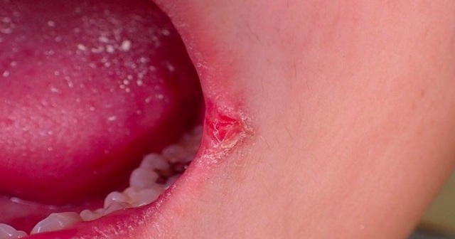 口角炎で唇が切れる原因とすぐに効く薬とは 不足しているのはあのビタミンだった 100テク