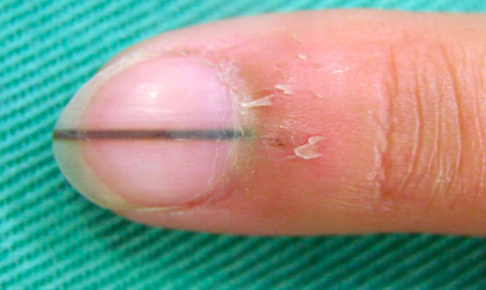 爪に短い黒い線がうっすらとある場合の治し方って 考えられる原因を知って危険性の高い病気から身を守ろう 100テク