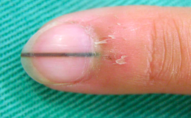 爪に短い黒い線がうっすらとある場合の治し方って 考えられる原因を知って危険性の高い病気から身を守ろう 100テク