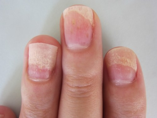 医師は爪の白い斑点をどのように診断するのでしょうか?